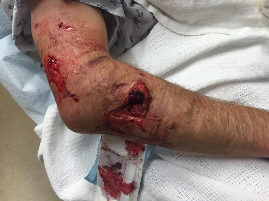 Schaffs arm wound due to bear attack